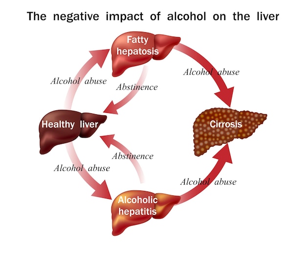 Stages of liver disease leading to cirrhosis