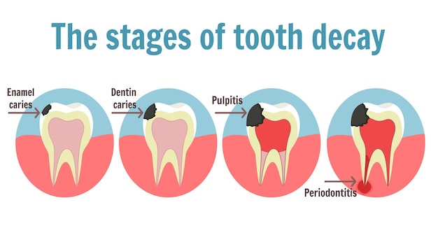 The stages of tooth decay infographic. Illustration of tooth with caries, pulpitis and periodontitis