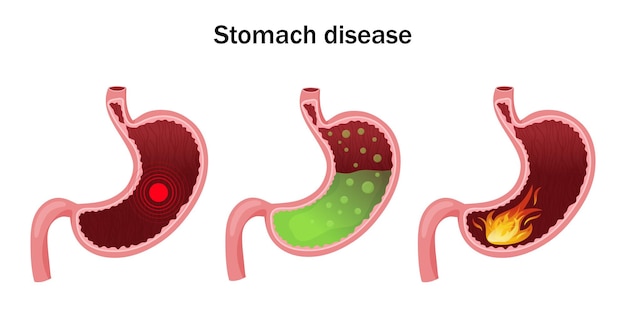 Stomach disease Pain increased acidity and burning in stomach Vector illustration cartoon style