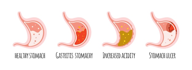 The stomach of a healthy person with ulcers gastritis acidity Gastroenterology Vector illustration