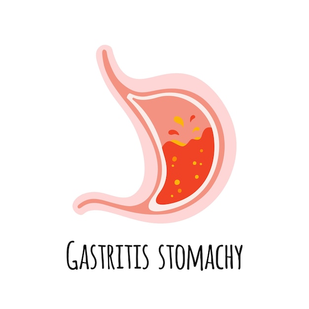 The stomach of a person with gastritis Gastroenterology Vector illustration in a flat