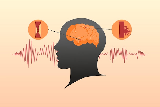 Vector stroke disease concept ischemic and hemorrhagic scientific medical illustration of human brain stroke vector illustration