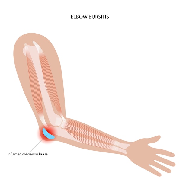 Student elbow bursitis