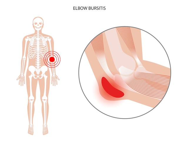 Student elbow bursitis