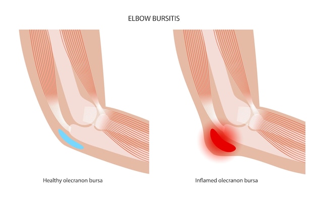 Student elbow bursitis