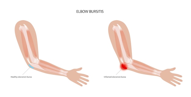 Student elbow bursitis