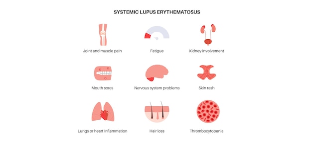 Vector systemic lupus erythematosus