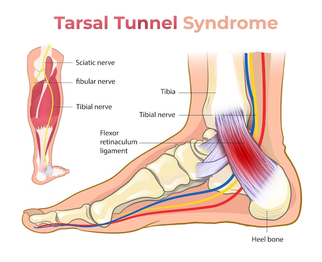 Vector tarsal_tunnel_syndrome