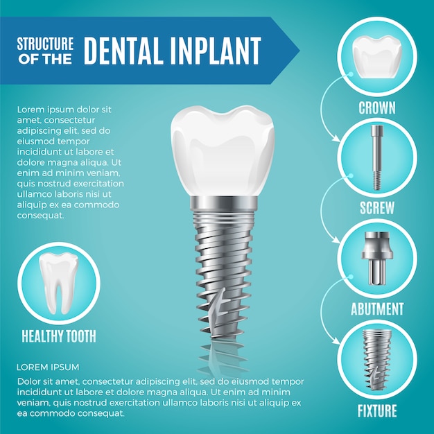 Teeth maquette. Structural elements of dental implant. Infographic for medicine