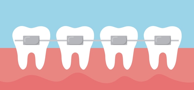 Teeth row with braces. Cute vector teeth with bracket in gum. Cartoon teeth orthodontic treatment.