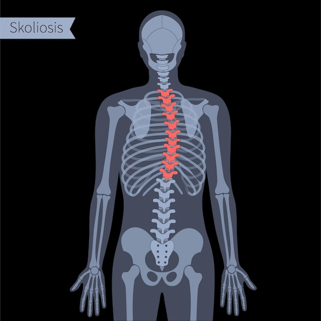 Thoracic scoliosis in human body. XRay flat vector illustration. Spine, backbone, joint and skeleton anatomy in male silhouette. Orthopedic poster. Medical banner. Exam in spinal pain center, clinic