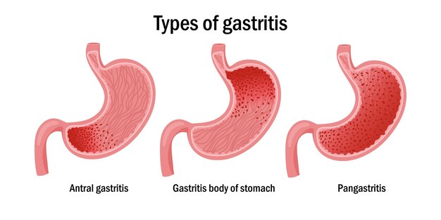 Vector three types of gastritis illustration