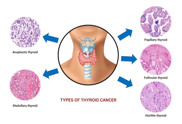 Vector thyroid cancer