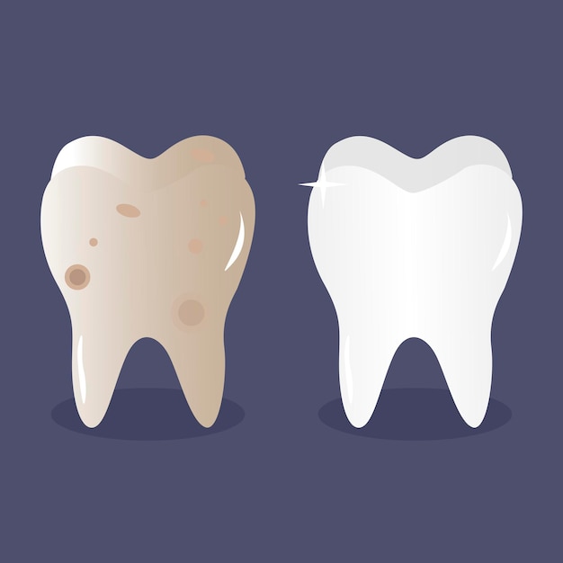 Tooth before and after bleaching and cleaning