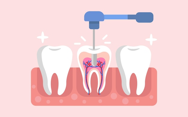 Tooth drill Medical dental drill concept flat vector illustration design