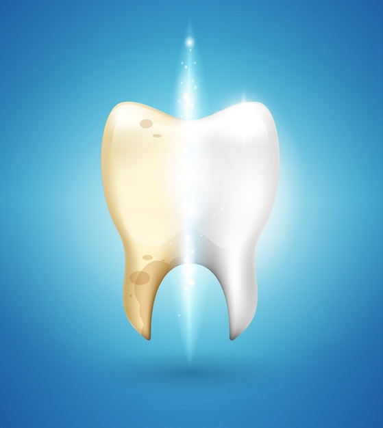 Tooth whitening in 3d style. Dental brushing of calculus and caries removal.