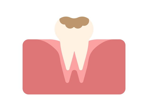 Tooth with caries. Tooth decay. Bad tooth. Dental care background. Unhealthy teeth. Vector