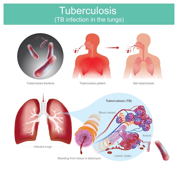 Tuberculosis TB infection in the lungs. Patients with respiratory infections. Caused by tuberculosis bacteria. tuberculosis bacteria bite the tissue, resulting in leakage of blood vessel.
