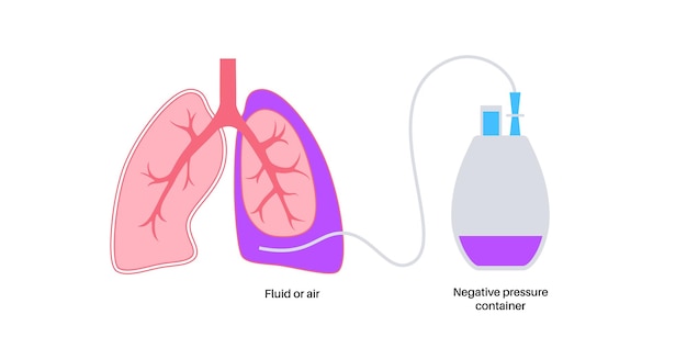 Tunneled pleural catheter