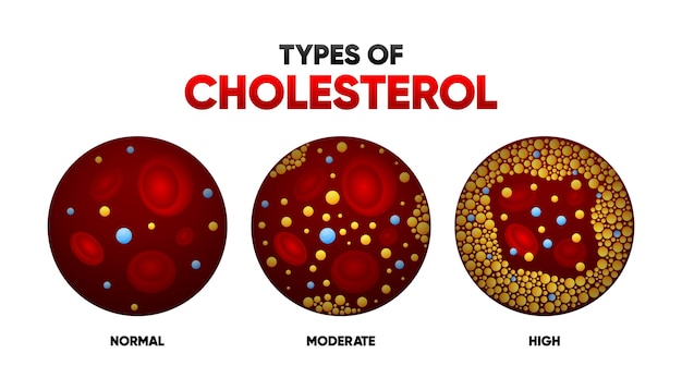 Types Cholesterol in flat style LDL and HDl level Arteriosclerosis infarct thrombosis disease