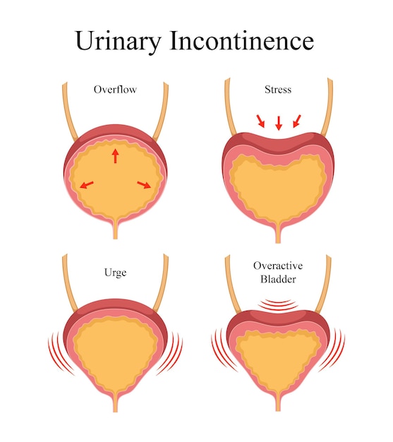 Vector types of human urinary incontinence