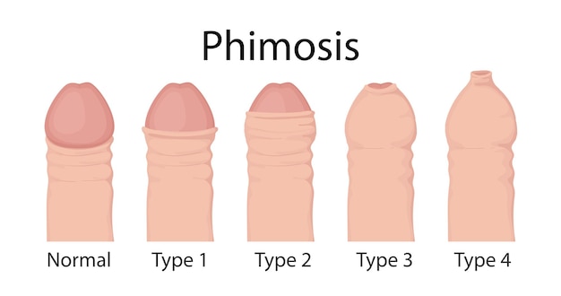 Types of phimosis penis medical vector illustration