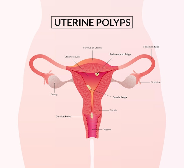 Types of Uterine Polyp Female reproductive system diseases