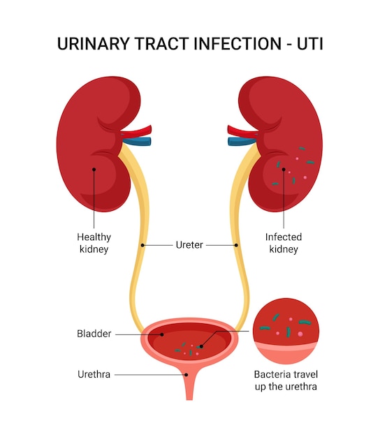 Vector urinary tract infection uti symptoms