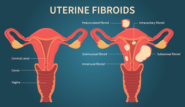 Uterine fibroids in the female reproductive system