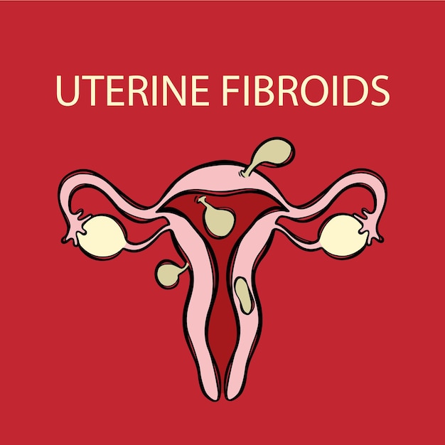 UTERINE FIBROIDS VS NORMAL Female Reproductive Education Set