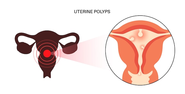 Vector uterus polyps