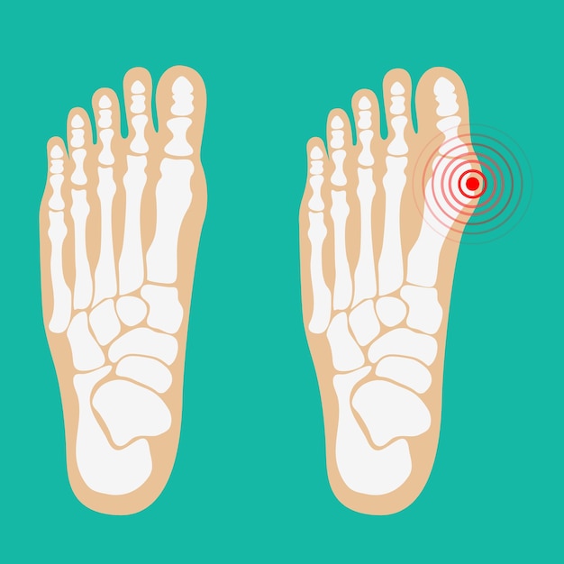 Vector valgus deformity of the big toe foot health care vector illustrations