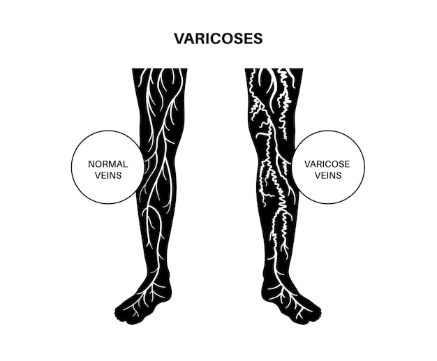 Vector varicose veins treatment