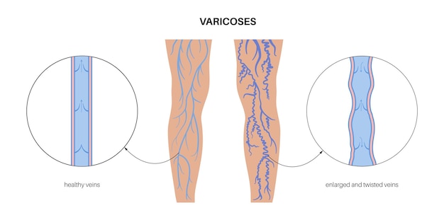 Vector varicose veins treatment