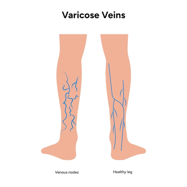 Vector varicose veins venous nodes healthy leg