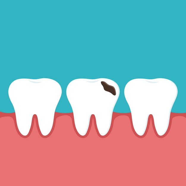 Vector dental medical illustration of a healthy tooth and a tooth with decay and a gum hole