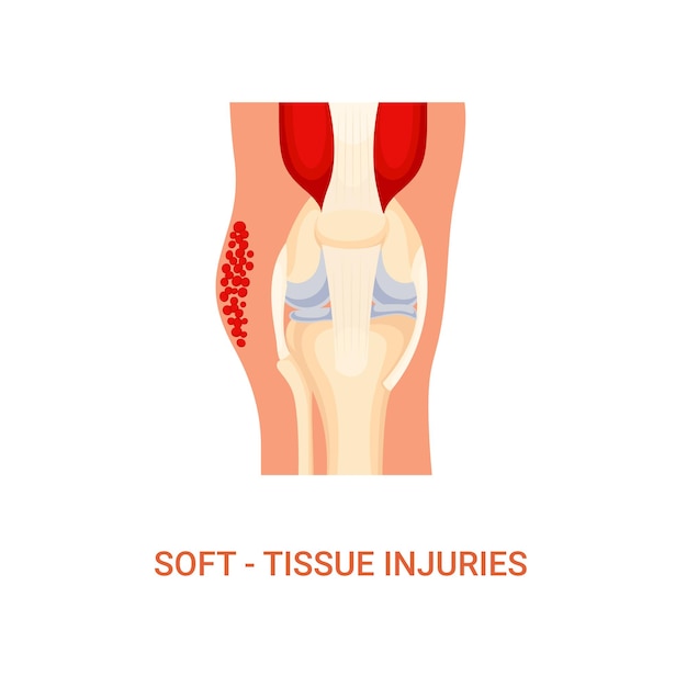 Vector of Human Diagnosis of Soft Tissue Injury Disease