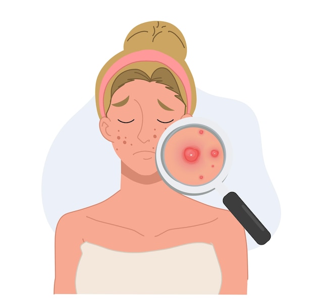 Vector illustration about Acne skin problems Concept woman with magnifying glass is looking acne on her facial