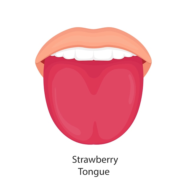 Vector illustration of strawberry tongue