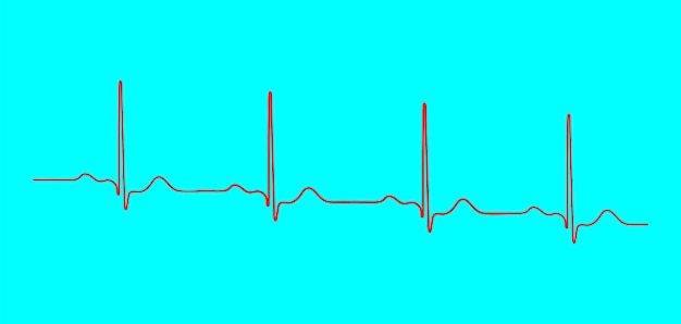 Vector ventricular repolarization cardiac cycle ecg of heart in normal sinus rhythm qt interval of ecg