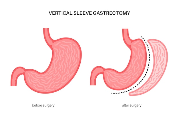 Vertical sleeve gastrectomy laparoscopy Stomach surgery weight loss gastric procedure