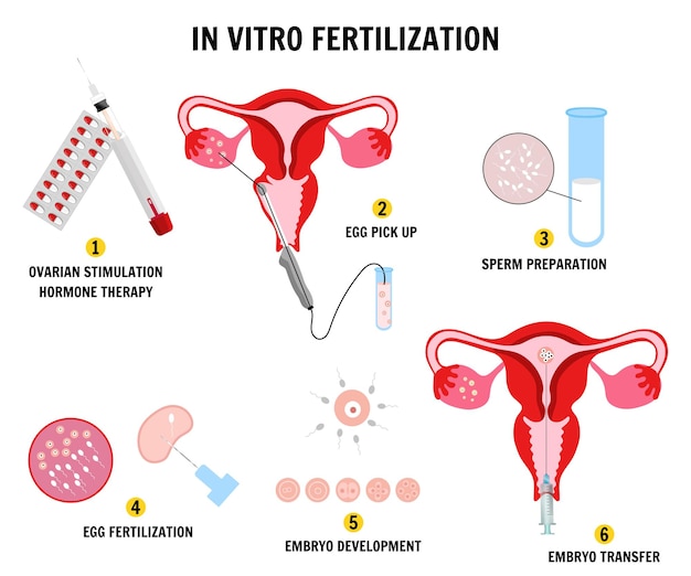 In vitro fertilization composition with sperm preparation in vector