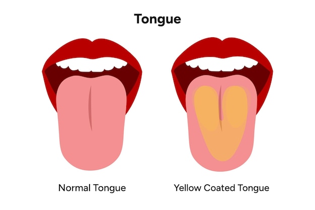 Yellow coated tongue