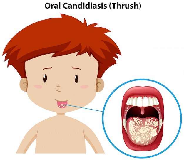 A Young Boy with Oral Candidiasis