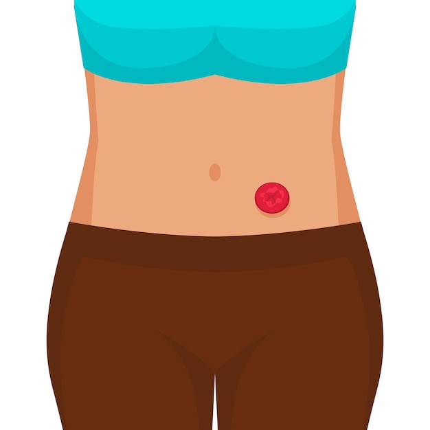 Vector young woman with stoma after colon cancer surgery